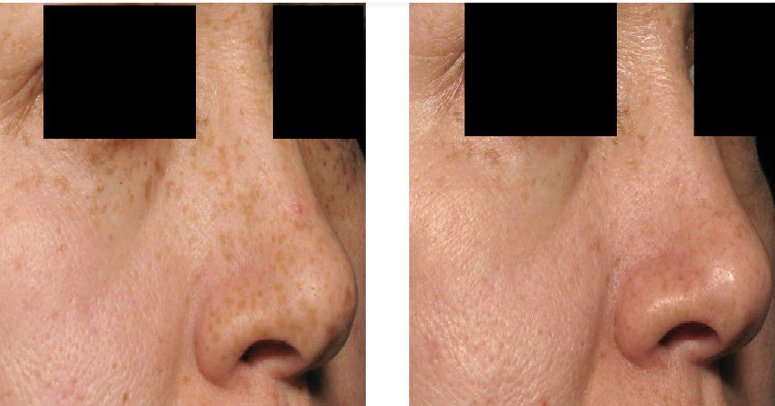 Selecting An Appropriate Nose Surgeon In Lisle IL