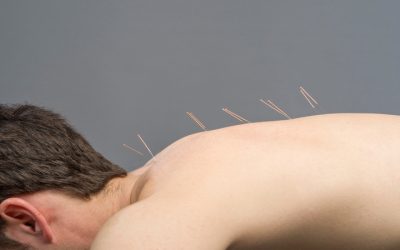 Acupuncture Treatment In Costa Mesa CA Is An Alternative Medicine To Get Relief From Pain