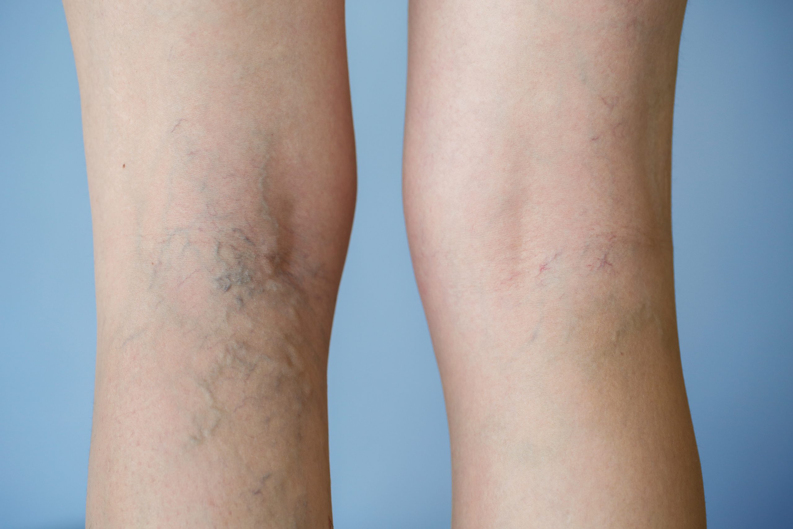 Find Lasting Relief with a Trusted Vein Care Specialist in Schaumburg
