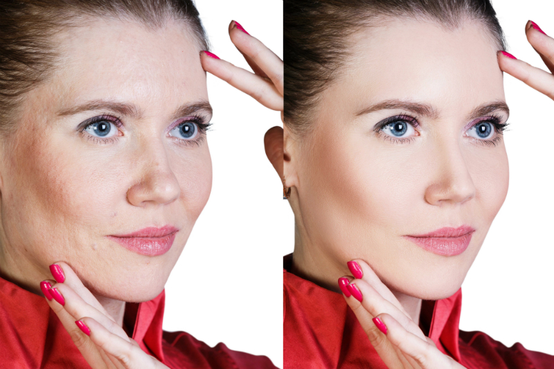 The Difference Between Skin Tightening and Lifting