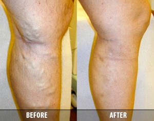 When It Comes to Endovenous Laser Ablation in Schaumburg, IL Offers It