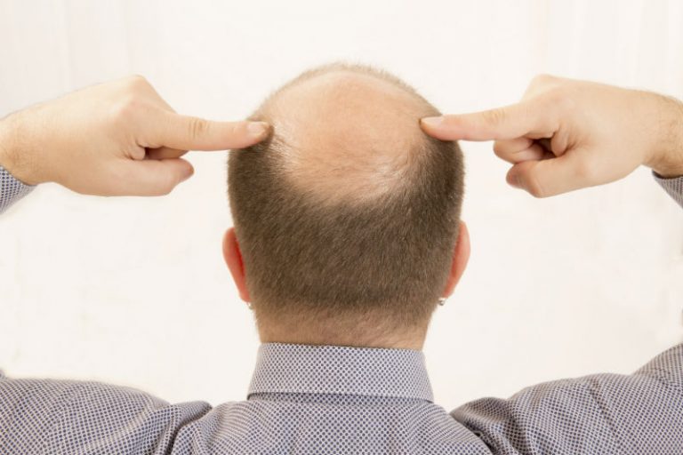 Follicular Unit Transplantation For Hair Restoration in New Jersey