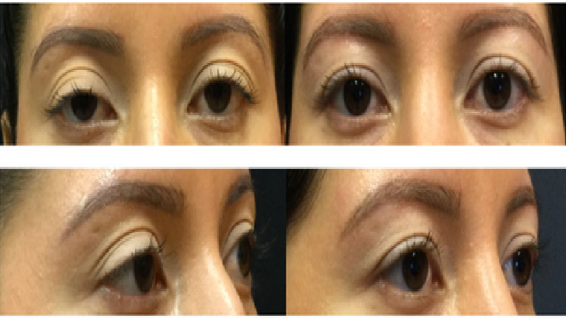 Doctors Who Perform Professional Blepharoplasty Eyelid Surgery in Minneapolis, MN, Work with All Types of Patients