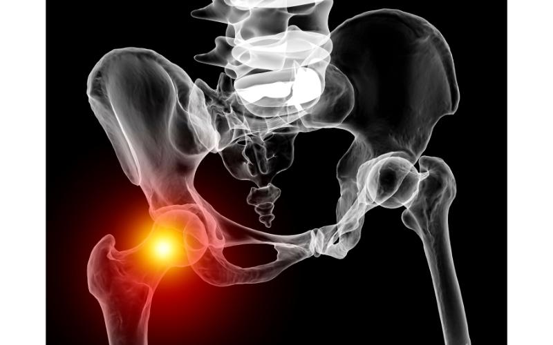 Getting Prompt Treatment after a Hip Replacement in New Warwick, RI