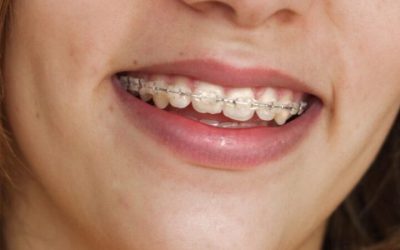 Reasons to Consider Braces for Adults in Medina, OH for Your Teeth