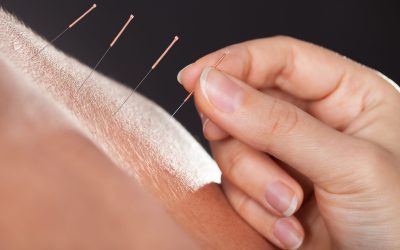 Discover natural balance at an Acupuncture Clinic in Burbank, CA