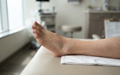 A Guide to Non-Surgical and Surgical Bunion Treatment